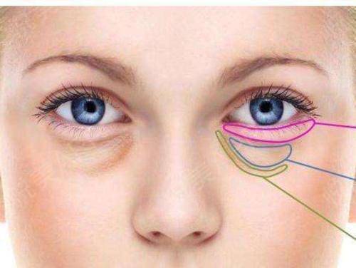 外切眼袋的過程是什么樣子的？