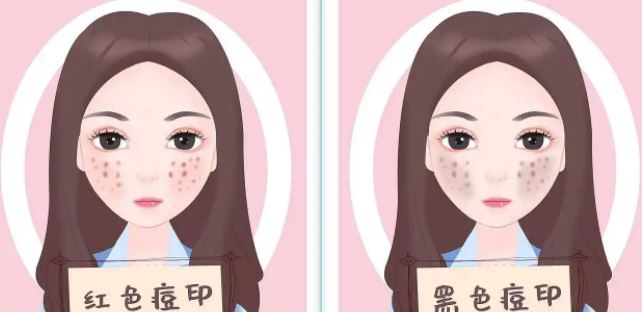 臉上紅色痘印幾個月都不消怎么辦？紅色痘印應(yīng)該怎么消除？