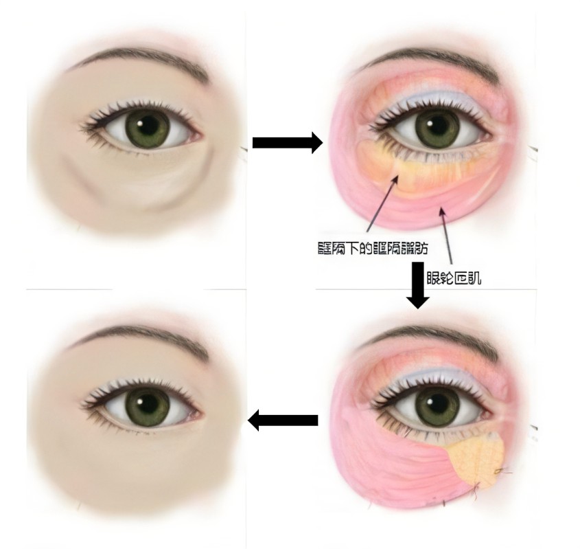 消除眼袋的方法有哪些？