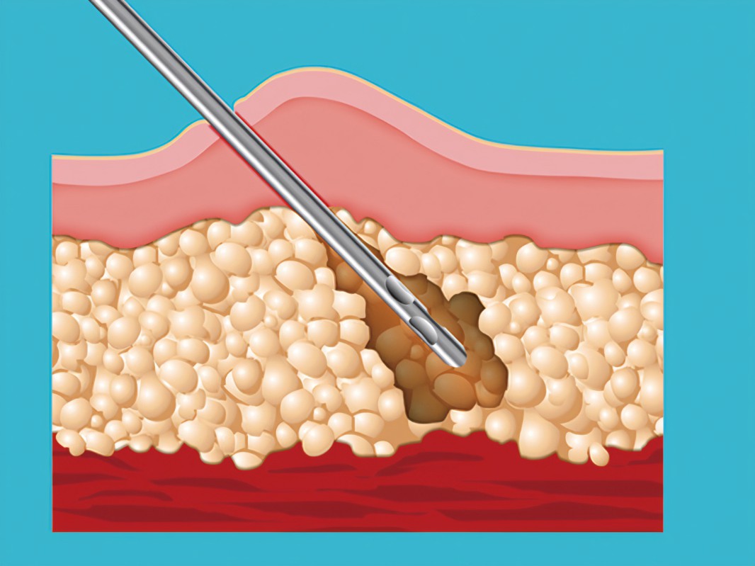 胸太大可以抽脂嗎多少錢？