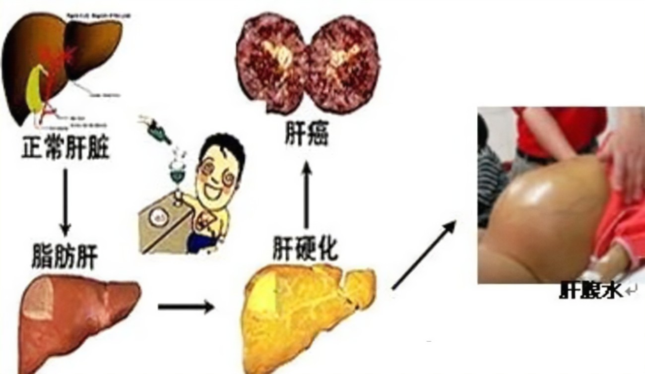 查出肝硬化還有救嗎？