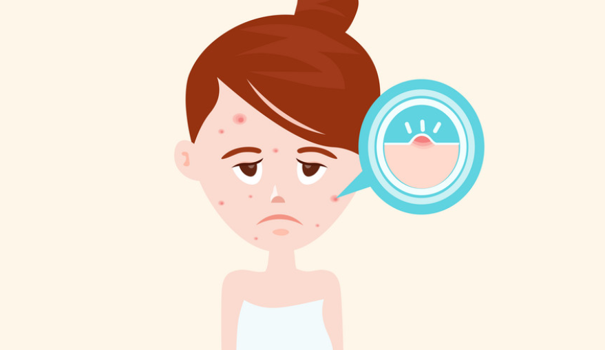 青春痘有救了嗎？聽說(shuō)青春痘也有疫苗了？