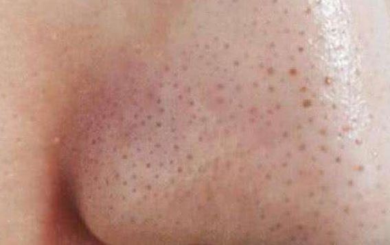 清潔面膜哪個牌子可以快速祛黑頭？趙薇、薇婭 推薦的紐西之謎泥膜真的好用嗎？